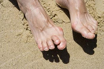 Causes, Symptoms, and Treatment Options for Hammertoe