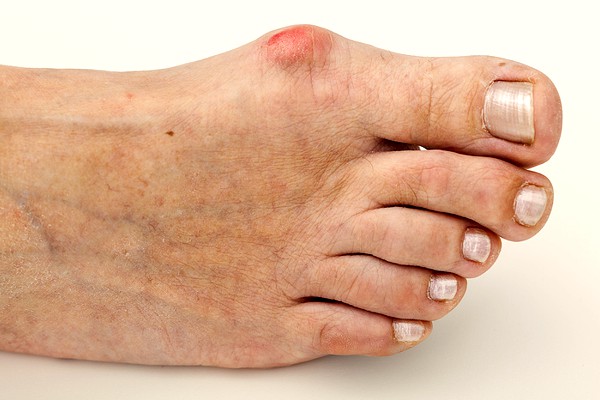 Botox Foot Treatment