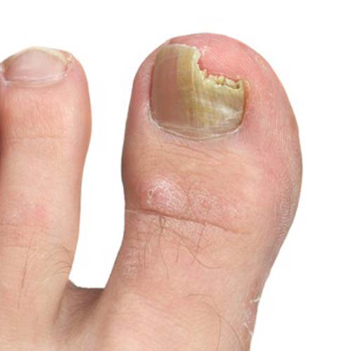 Toe nail fungus treatment
